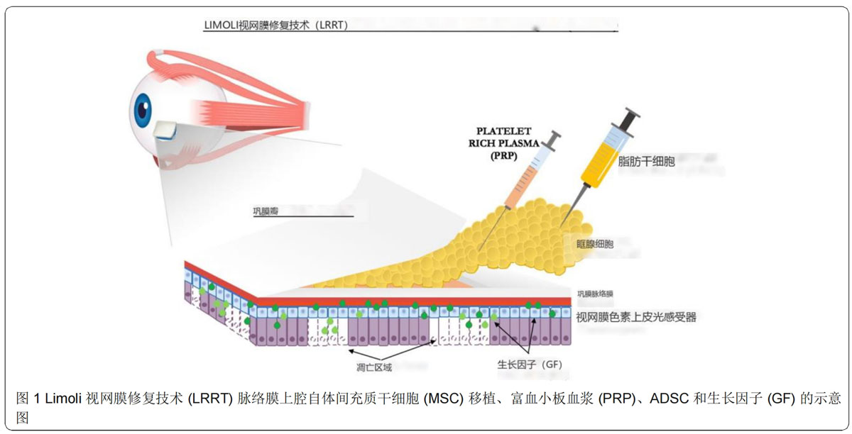 青光眼臨床試驗(yàn) 青光眼臨床試驗(yàn)