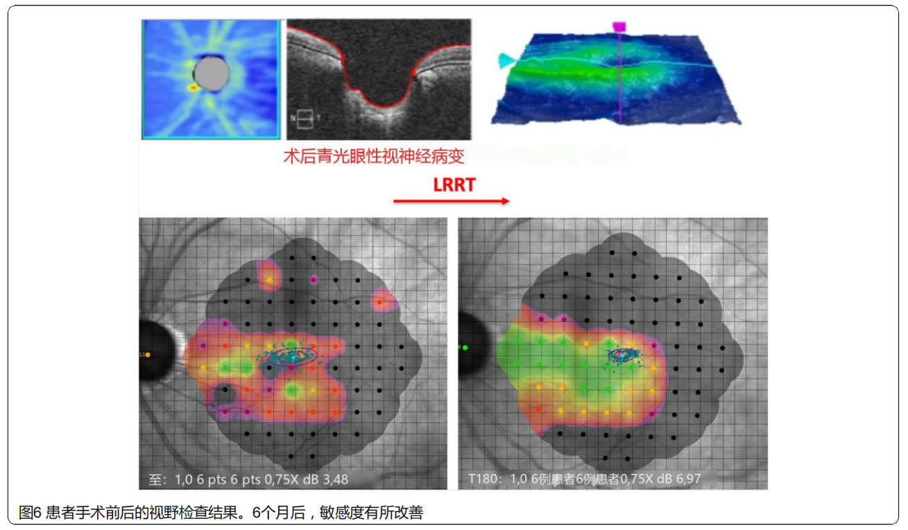 青光眼臨床試驗(yàn) 青光眼臨床試驗(yàn)