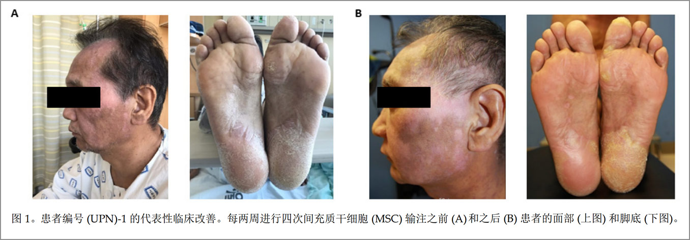 GVHD臨床試驗(yàn) GVHD臨床試驗(yàn)