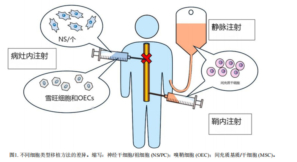 干細胞治療脊髓損傷 干細胞治療脊髓損傷