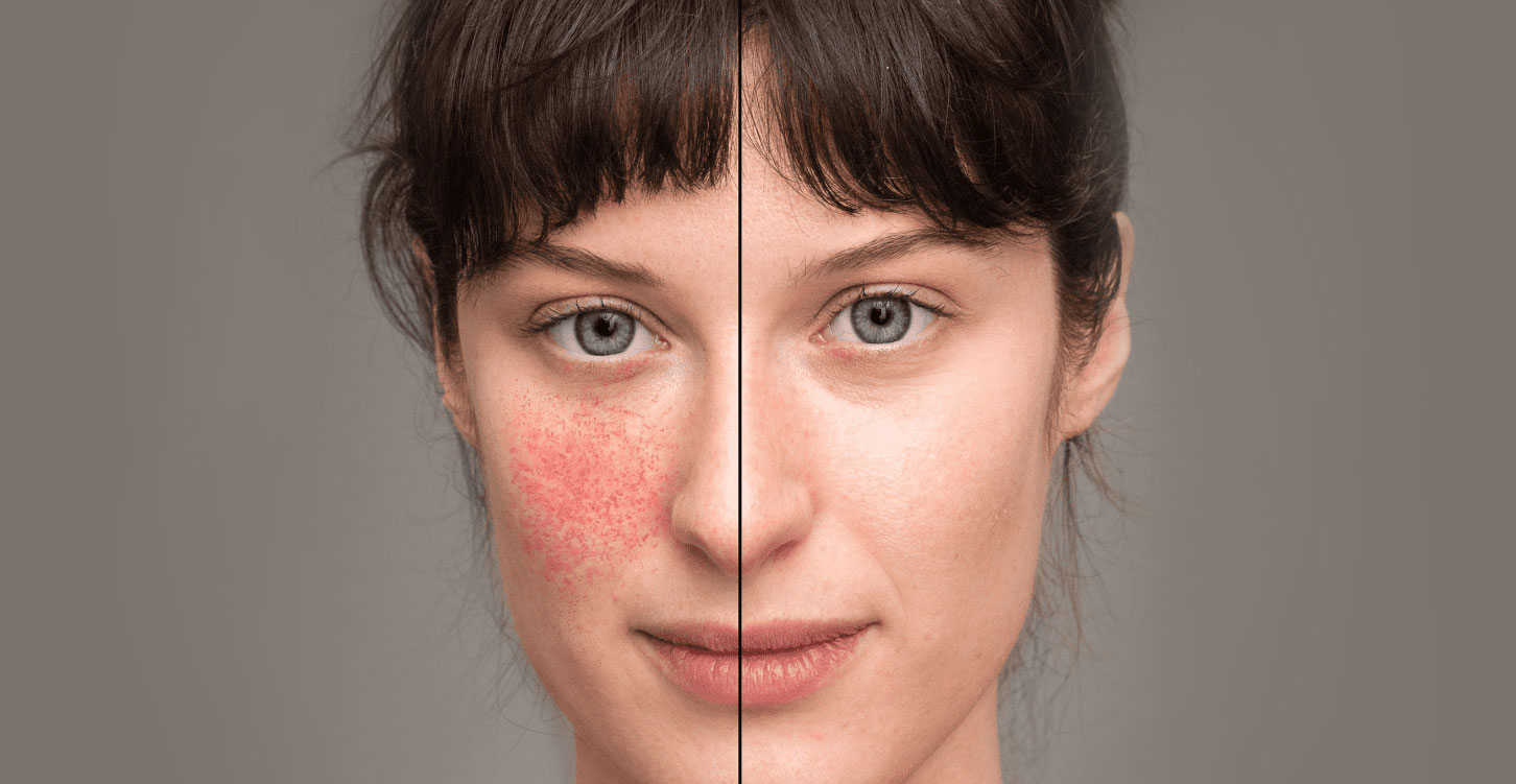 紅斑狼瘡 紅斑狼瘡