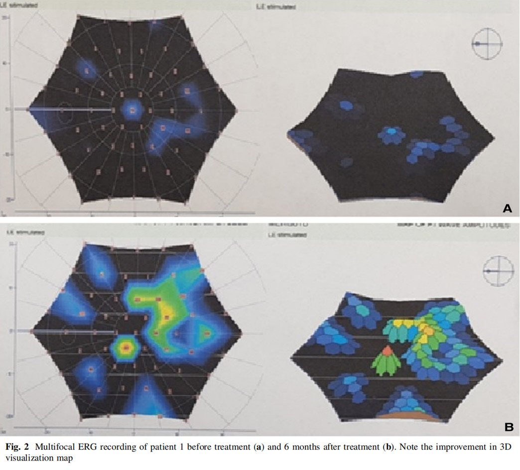 視神經萎縮臨床試驗 視神經萎縮臨床試驗
