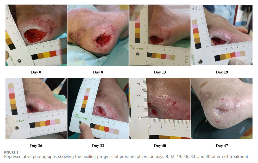 壓瘡臨床試驗 壓瘡臨床試驗