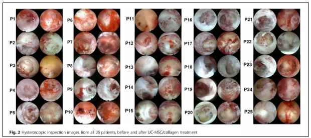 宮腔粘連 宮腔粘連