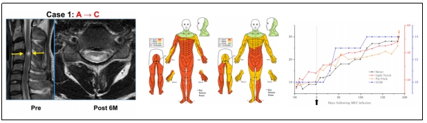 脊髓損傷 脊髓損傷