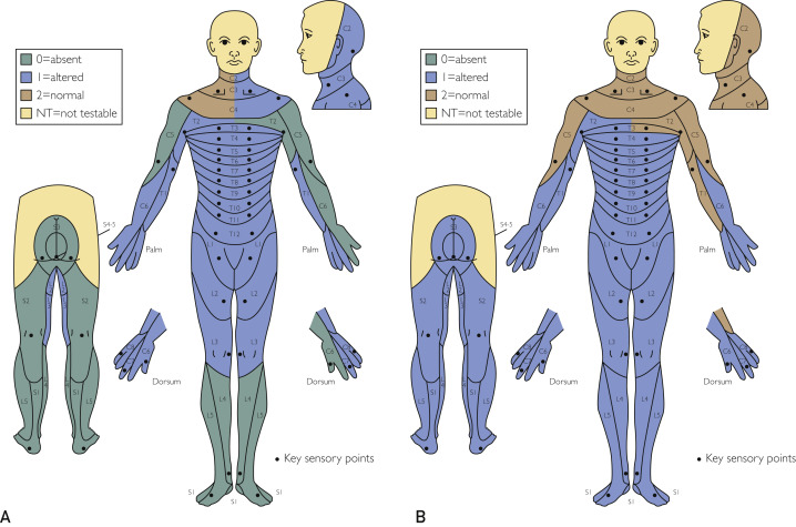 圖2:根據(jù)脊髓損傷神經(jīng)學分類國際標準,在基線(A)和 18 個月隨訪(B)時形成的皮節(jié)感覺評分。 圖2:根據(jù)脊髓損傷神經(jīng)學分類國際標準,在基線(A)和 18 個月隨訪(B)時形成的皮節(jié)感覺評分。