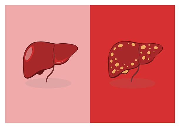 國內(nèi)外干細(xì)胞治療肝硬化進(jìn)展對比:哪項技術(shù)更成熟、效果更好? 國內(nèi)外干細(xì)胞治療肝硬化進(jìn)展對比:哪項技術(shù)更成熟、效果更好?