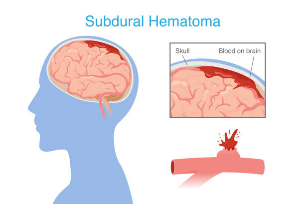 神經(jīng)干細胞移植治療腦出血的系統(tǒng)評價:NSC來源、輸送途徑、治療機制和早期臨床試驗 神經(jīng)干細胞移植治療腦出血的系統(tǒng)評價:NSC來源、輸送途徑、治療機制和早期臨床試驗