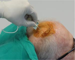 干細胞注射到大腦過程。